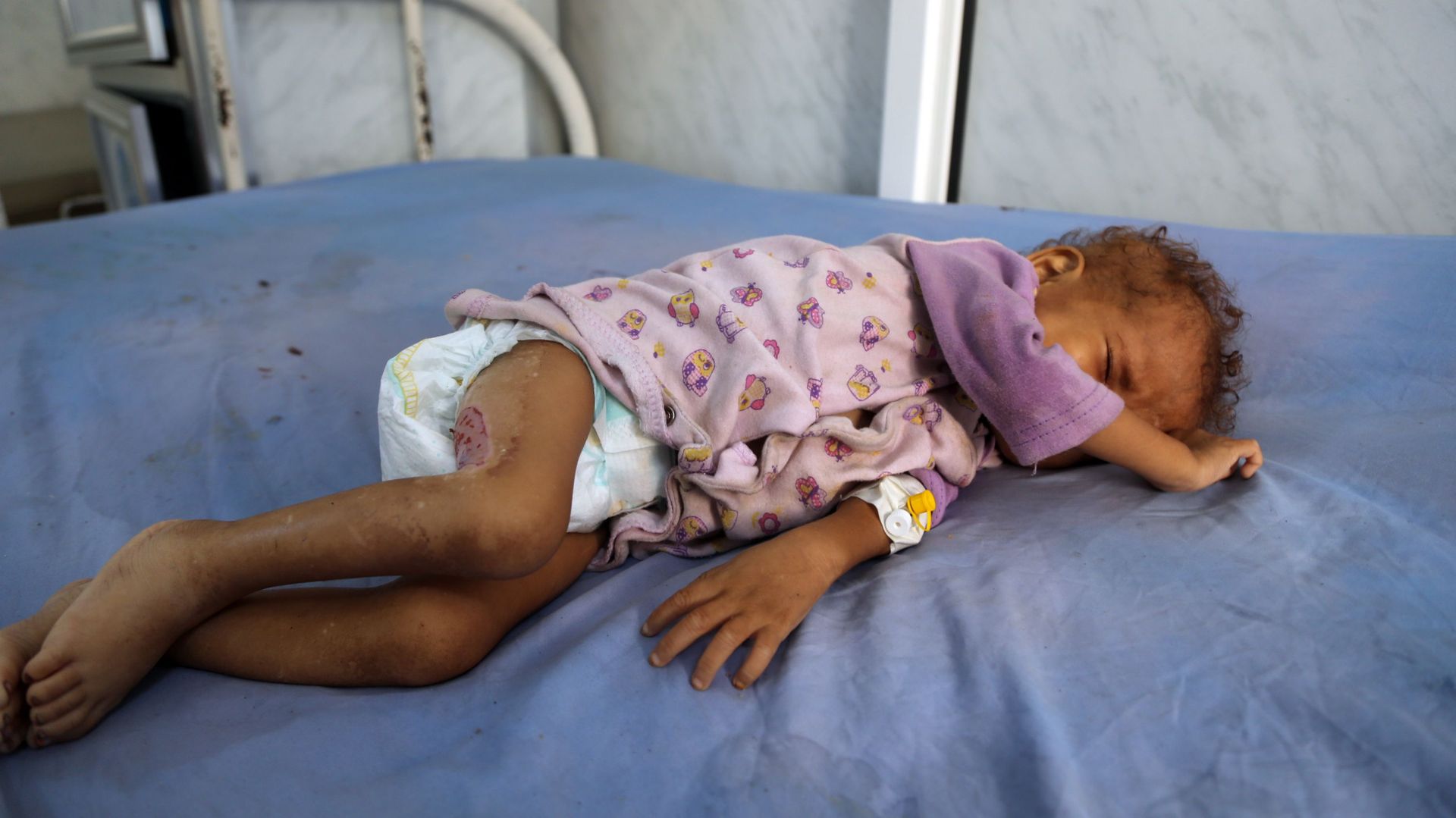 Yémen : le nombre de décès dus au choléra à Taiz est passé à 52 depuis début 2024