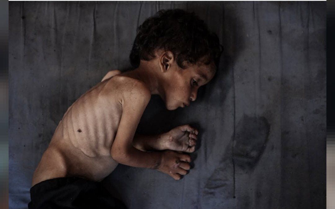 المجاعة تفتك بأطفال غزة