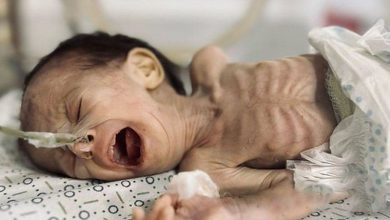 اليونيسف: 26 ألف طفل في غزة بحاجة عاجلة لعلاج سوء التغذية الحاد