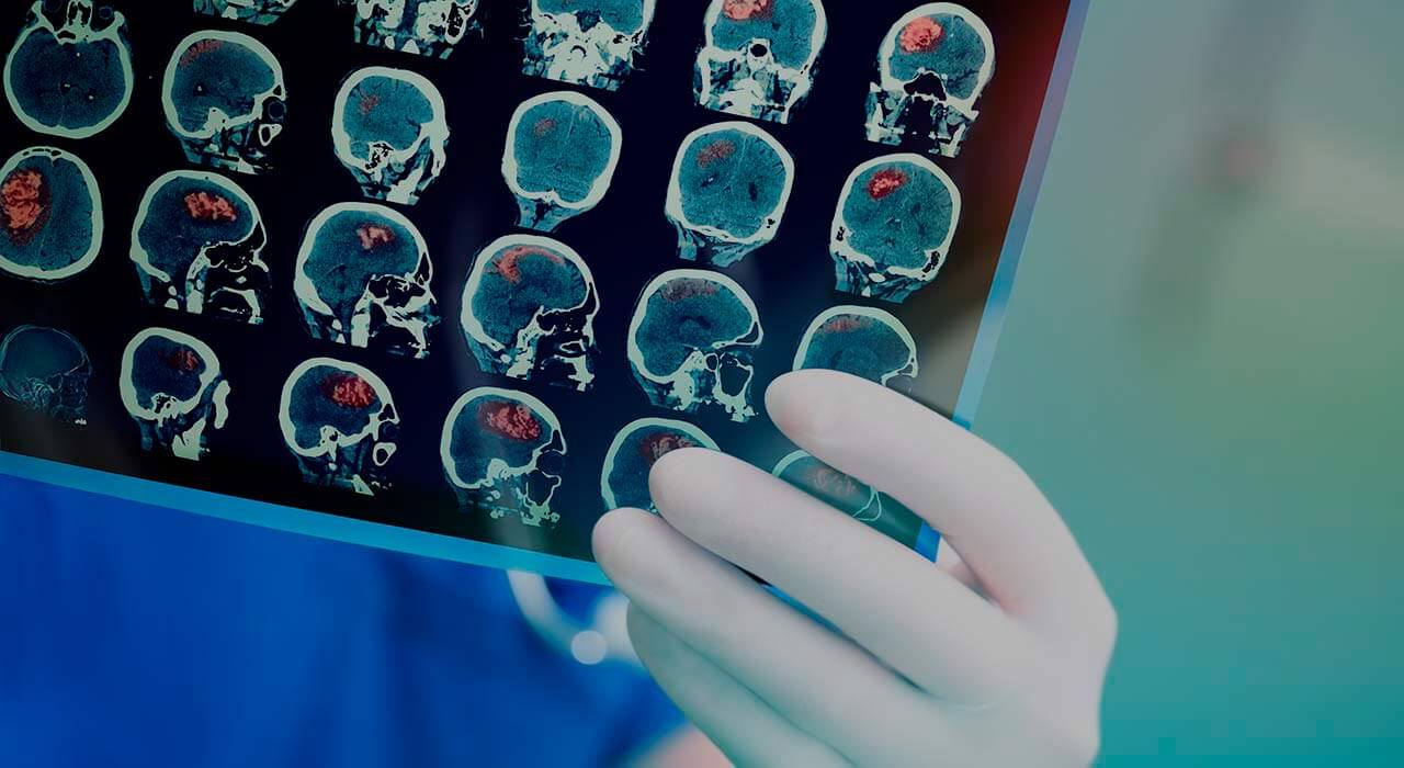 اكتشاف دواء جديد لعلاج نوع خطير من سرطان المخ